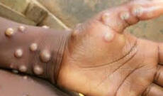 Pakistanda meymunçiçəyinə ilk yoluxma qeydə alınıb