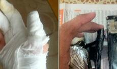 Birinci sinif şagirdinin telefonu partladığına görə o, xəstəxanaya yerləşdirilib