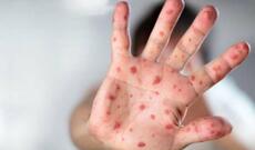 Azərbaycanda daha bir uşaq qızılcanın qurbanı oldu