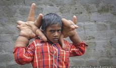 Hindli uşağın əməliyyata ehtiyacı var