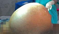 Qadının qarnından fil balası ağırlığında şiş çıxdı - FOTO