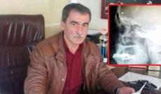 Beynində unudulan güllə ilə 40 il yaşadı