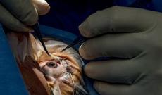 Səhiyyəmizdə nadır əməliyyat: Gözün buynuz qişasının transplantasiyası-Video