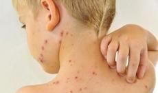 Praqanı qızılca epidemiyası cənginə alıb