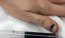 Ağrıkəsici qəbul edən 25 yaşlı qızın qanı gömgöy oldu